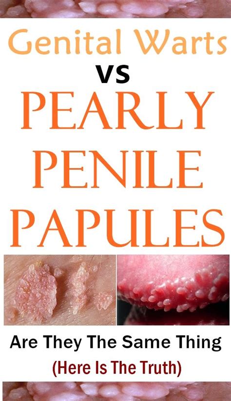 papule perlee penis|Pearly Penile Papules: Causes, Symptoms & Treatment